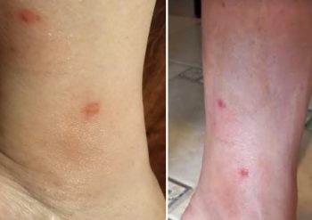 Picada de Butuca pode Inflamar – Sintomas e Cuidados com Mutucas